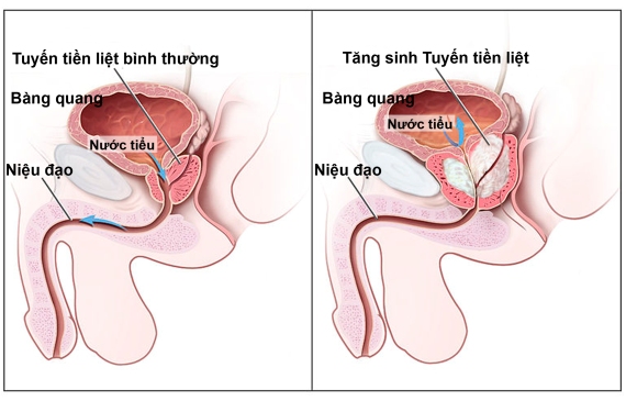 cac-trieu-chung-phi-dai-tien-liet-tuyen