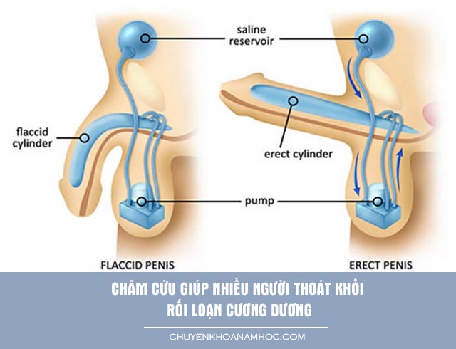 châm cứu chữa rối loạn cương dương 